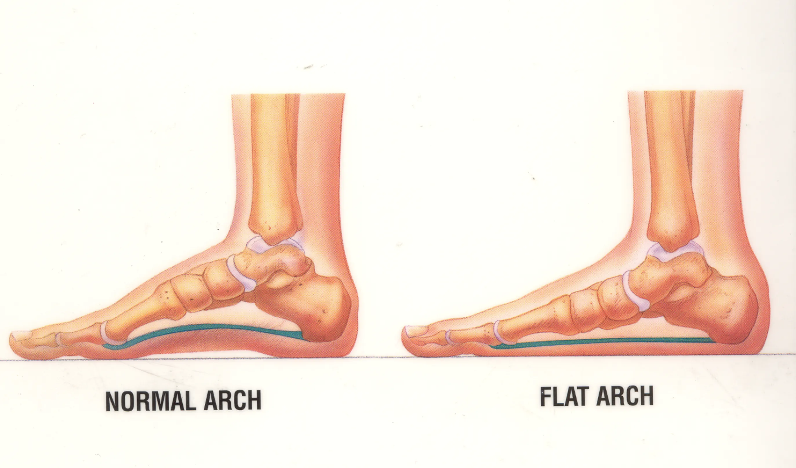 Diagram comparing a normal foot arch with a flat arch