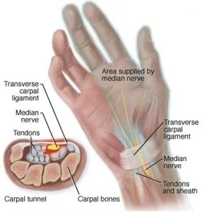 Anatomical diagram showing the median nerve and carpal tunnel at the wrist