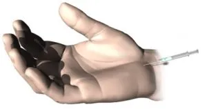 Illustration of an injection near the wrist