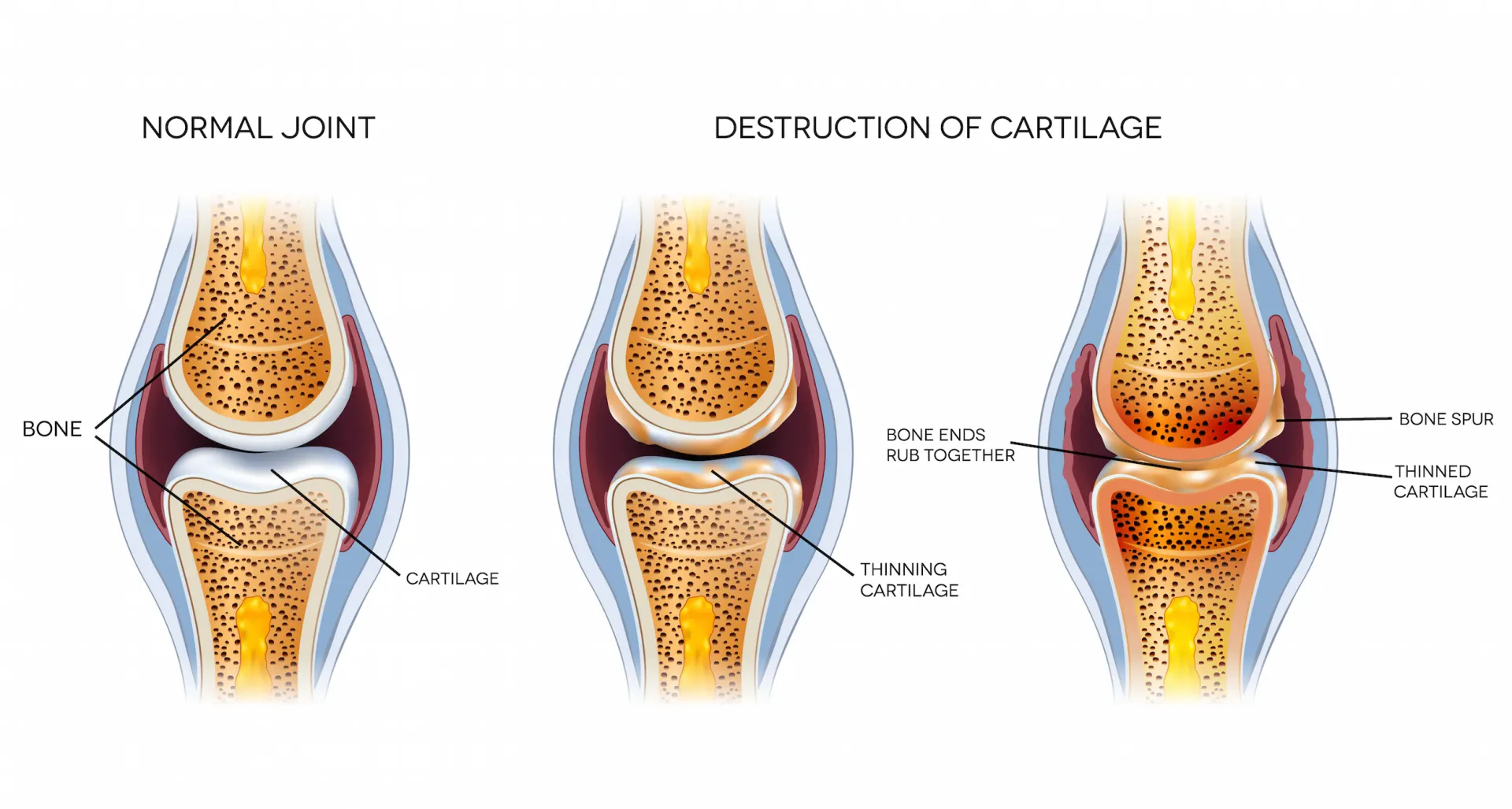Diagram comparing a normal knee joint with cartilage deterioration