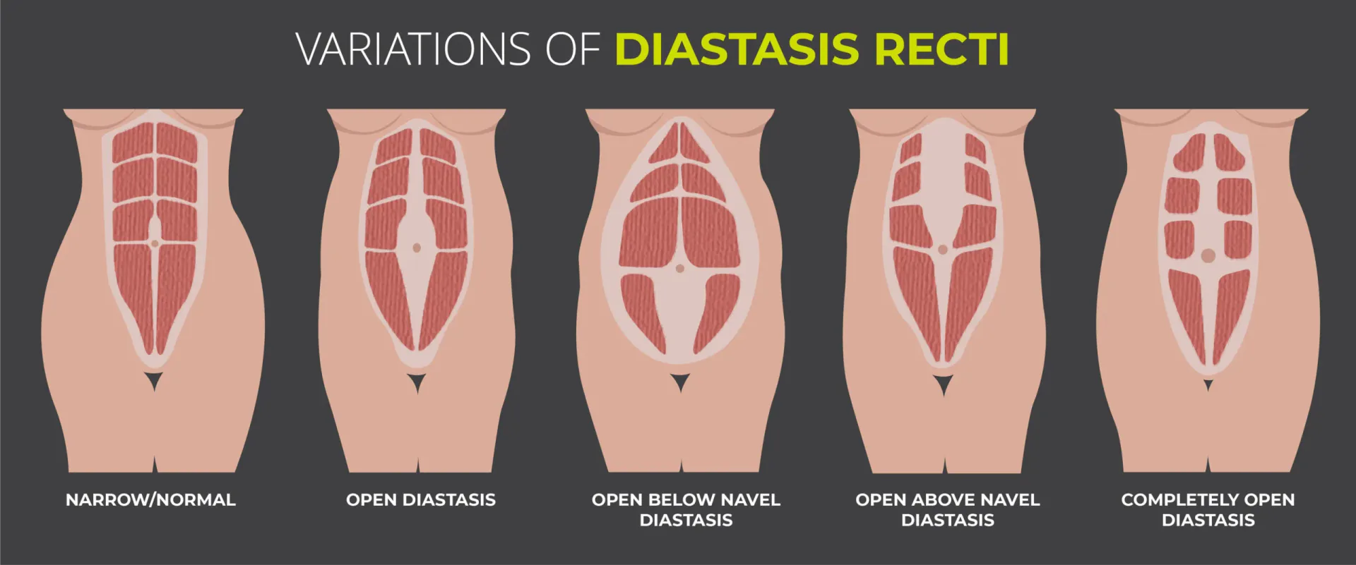 Diagram showing variations in abdominal muscle separation