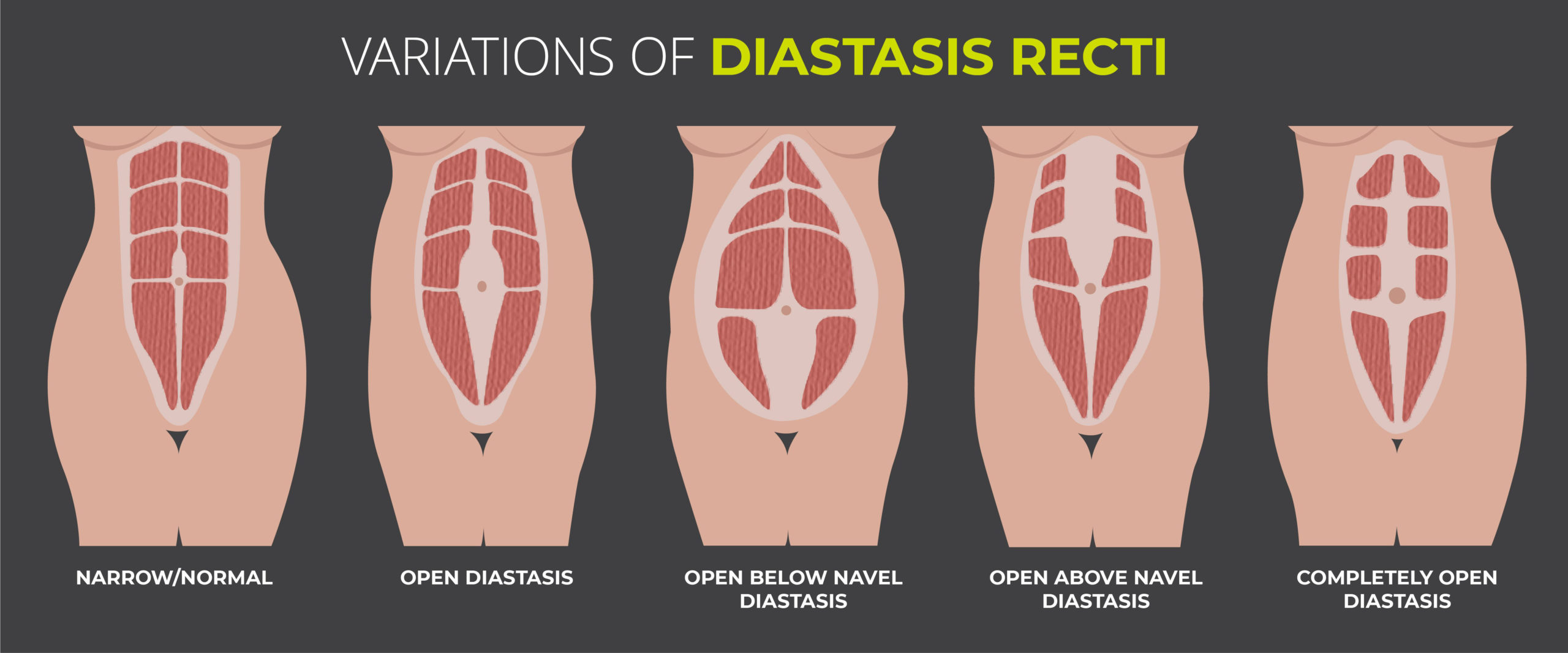 diastasis recti examplea
